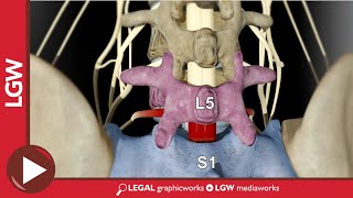 L5S1 Posterior Lumbar Interbody Fusion 3D Animation [upl. by Maryly]