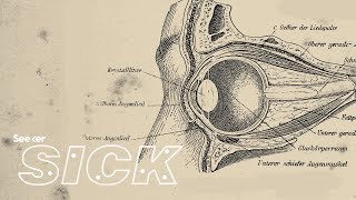 Normal Low Tension Glaucoma Malik Y Kahook MD [upl. by Nuahsad]