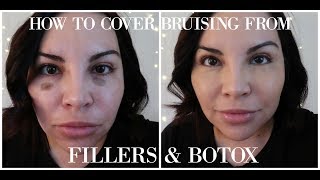 HOW TO COVER BRUISING FROM FILLERS amp BOTOX [upl. by Uwkuhceki]