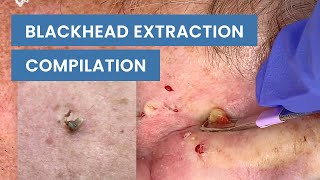 Extraction Satisfaction Blackhead Removal  CONTOUR DERMATOLOGY [upl. by Debbi]