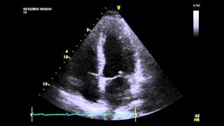 Paradoxical Motion of Interventricular Septum [upl. by Valene]