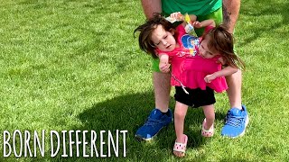 Miracle Conjoined Twins Learning To Walk  BORN DIFFERENT [upl. by Robyn]