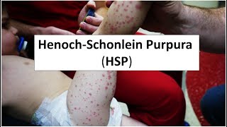 HenochSchonlein Purpura HSP [upl. by Aubrie427]