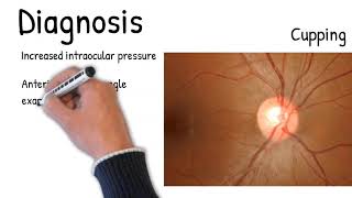 Understanding Glaucoma Diagnosis Treatment and Research on the Horizon [upl. by Eudoxia]