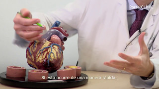 CARDIOPATÍA ISQUÉMICA FISIOPATOLOGÍA  GuiaMed [upl. by Garrik]