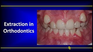 Extraction in Orthodontics [upl. by Maurice159]