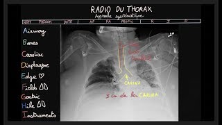 Phlébite et Embolie pulmonaire  12  STAFFs Saint Camille [upl. by Ylloj]