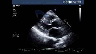 Ventricular Septal Defect VSD  Heart Auscultation  Episode 11 [upl. by Notyarb]