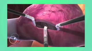 Deviated Septum Surgery Septoplasty [upl. by Elleron505]