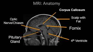 Normal Brain MRI Anatomy  Neuroradiology Made simple [upl. by Anirrehs829]