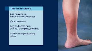 Venous InsufficiencyValvular Incompetence [upl. by Hailey]