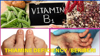 BeriBeri  Thiamine deficiency [upl. by Ived]