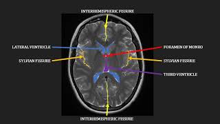 Introduction to MRI of the brain [upl. by Wei]