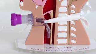 Clinical Complications of Tracheostomy [upl. by Avraham]