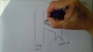 How superficial thrombophlebitis develops [upl. by Kearney]