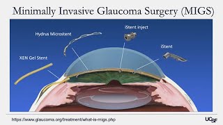 How to reverse chronic glaucoma naturally in 4 minutes a day [upl. by Kirby907]