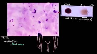 Diagnosing Malaria [upl. by Irbmac755]