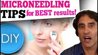 MICRONEEDLING DIY at HOME  What You Need to Know [upl. by Stepha]