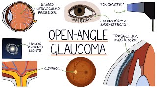 See What I See Glaucoma Virtual Reality Experience [upl. by Cynthy]