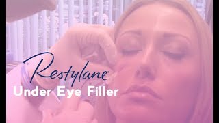 Restylane Under Eye Filler  Total Dermatology [upl. by Hawley]