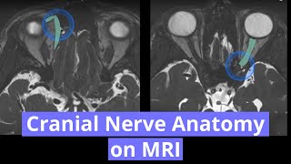 Cranial Nerve Anatomy on MRI [upl. by Llyrehc860]