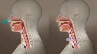 Avtrach Demonstration Tracheostomy Patient Avkin [upl. by Azar821]