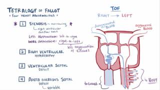 Tetralogy of Fallot 4 vessel view with colour Doppler [upl. by Dahle]