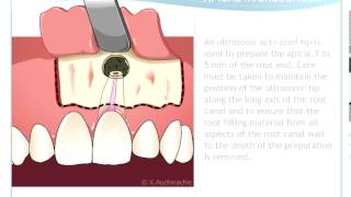 Endodontic Microsurgery [upl. by Gensmer35]