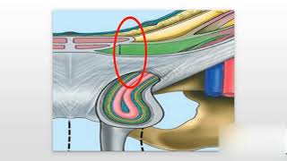 Inguinal Hernias Explained [upl. by Meyers848]