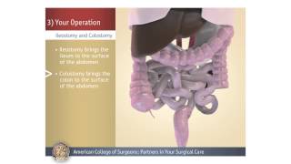 ColostomyIleostomy Your Operation [upl. by Woodhead]