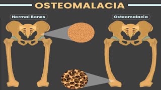 OSTEOMALACIA [upl. by Whallon]