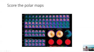 Reading a Normal Cardiac PET Scan [upl. by Iow]