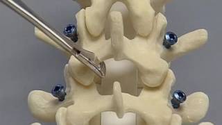 Posterior Lumbar Interbody Fusion PLIF spine surgery [upl. by Anifad751]