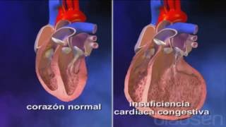 Insuficiencia Cardiaca Congestiva [upl. by Nirel]