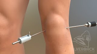 Rebound PostOp Knee – User Instructions [upl. by Nroht]