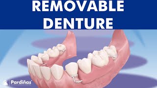 Removable partial denture © [upl. by Arbmik]