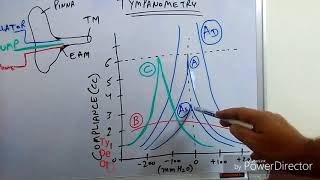 Tympanometry Impedance Audiometry [upl. by Marlowe59]