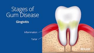 Erica FischerCartlidge Compares Magic Mouthwash and Preventive Measures for Oral Mucositis [upl. by Repard304]