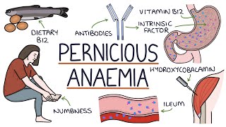 Understanding Pernicious Anaemia B12 Deficiency [upl. by Jehu]