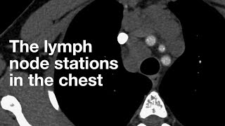 Having a lymph node biopsy [upl. by Baalman650]