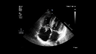 Live Webcast Myxomatous Mitral Regurgitation [upl. by Cire]