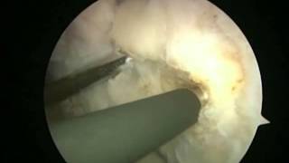 Arthroscopic Latarjet  BristowLatarjet Instability Shoulder System [upl. by Shirberg]