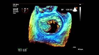 SYSTOLIC ANTERIOR MOTION OF THE MITRAL VALVE [upl. by Fogg]