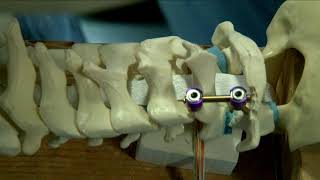 C1C2 posterior fixation techniques sawbone model demonstration [upl. by Hanway]