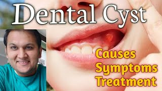 Dental Cyst and Infection Causes Symptoms Types and Treatment [upl. by Weatherby876]