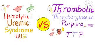 Hemolytic Uremic Syndrome HUS vs Thrombotic Thrombocytopenic purpura TTP [upl. by Anelet]