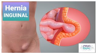 Ejercicios para Hernia Inguinal [upl. by Aihsem]