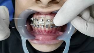 Orthodontic Ligation [upl. by Llerrut]