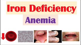 IronDeficiency Anemia Overview  Causes Pathophysiology Signs amp Symptoms Diagnosis Treatment [upl. by Hnahc384]