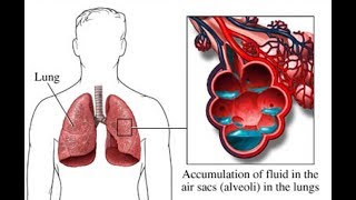 Semiologie de linsuffisance respiratoire Partie 1 [upl. by Savinirs]